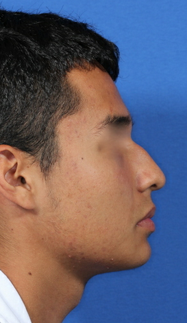nasal airway surgery with cosmetic improvement