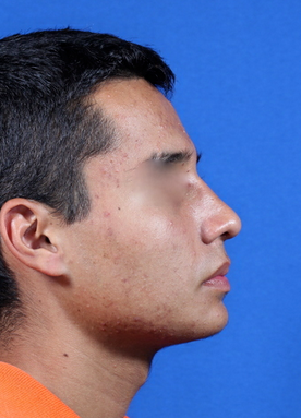 nasal airway surgery with cosmetic improvement