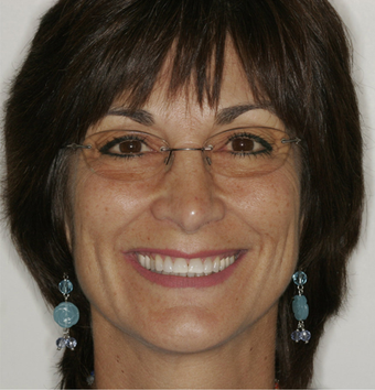 Smile makeover