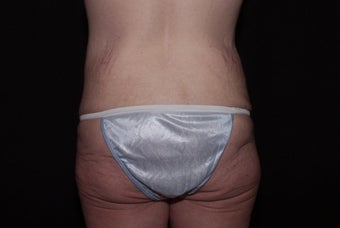 Body Lift