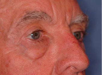 Extended lower lid blepharoplasty