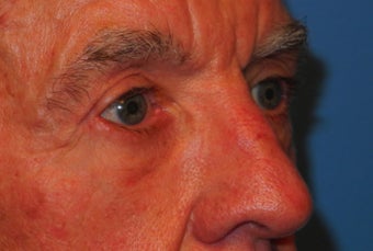Extended lower lid blepharoplasty