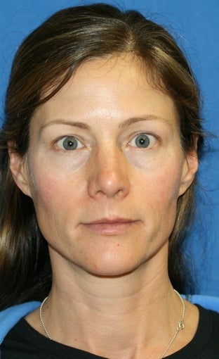 1 month post op: Full Face Fat Transfer