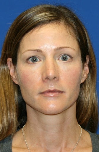 1 month post op: Full Face Fat Transfer