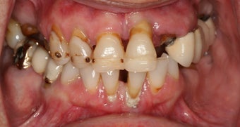 Implant supported overdentures