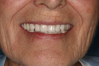 Implant supported overdentures