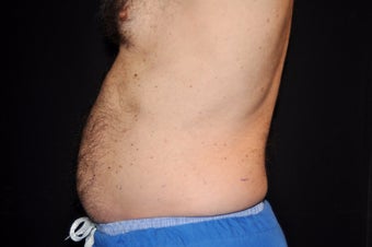 CoolSculpting