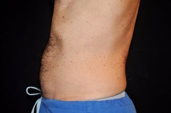 CoolSculpting