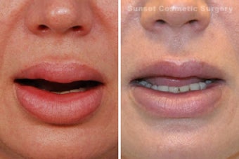 Lip Reduction and Repair