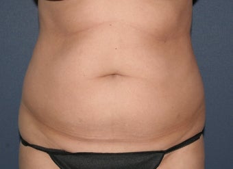 Liposculpture