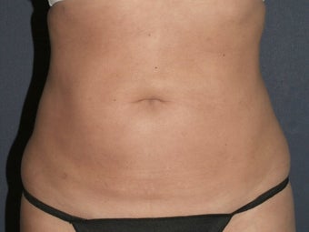 Liposculpture