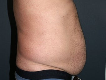 Body Liposculture
