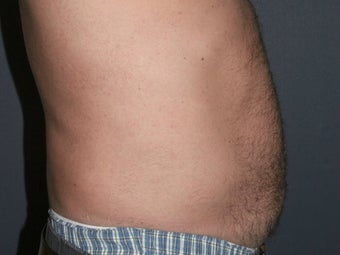 Body Liposculture