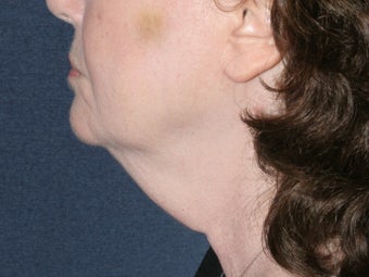 Liposculpture