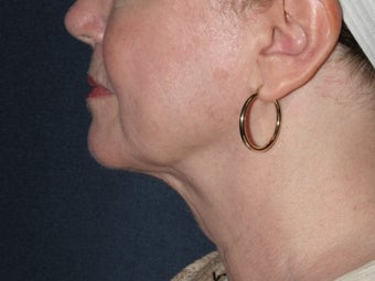 Liposculpture