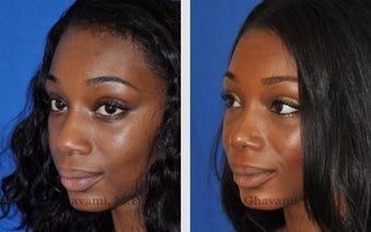 African American Ethnic Rhinoplasty