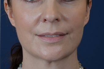 Lip Augmentation with Filler