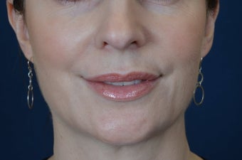Lip Augmentation with Filler