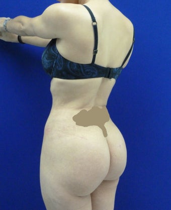 Brazilian butt Lift