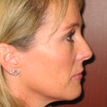Facelift
