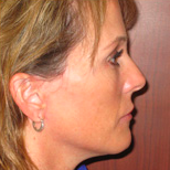 Facelift