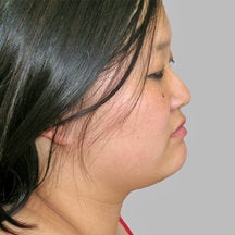 Chin Liposuction 