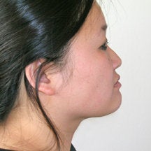 Chin Liposuction 