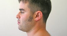Chin Liposuction 