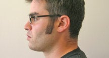 Chin Liposuction 