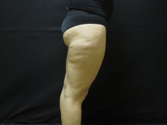 Cellulaze - Cellulite Treatment