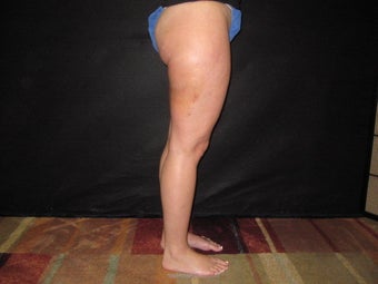 Cellulaze - Cellulite Treatment