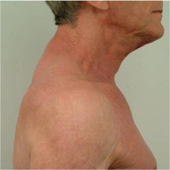 Buffalo Hump Reduction