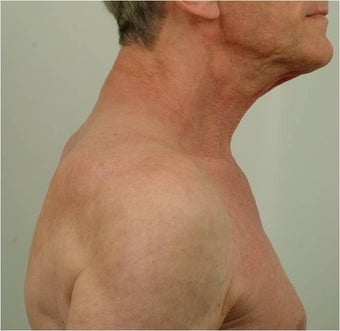 Buffalo Hump Reduction