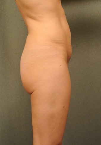 Butt Lift