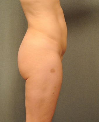 Butt Lift