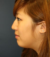 Rhinoplasty