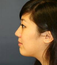 Rhinoplasty
