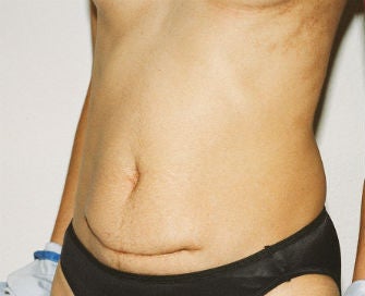 Abdominoplasty Revision