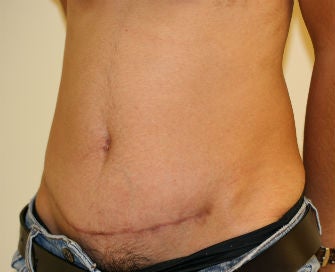 Abdominoplasty Revision