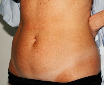 Mini-abdominoplasty