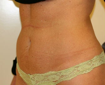 Mini-abdominoplasty