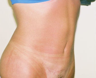 Mini-abdominoplasty