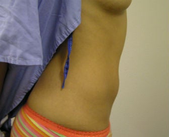 Mini-abdominoplasty