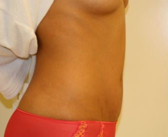 Mini-abdominoplasty