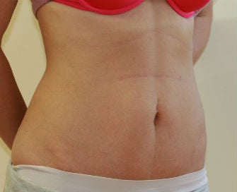 Mini-abdominoplasty