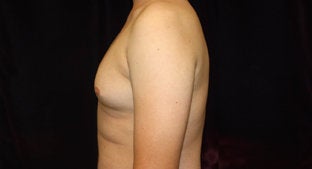 Gynecomastia 