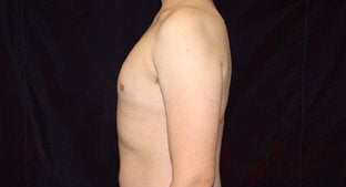 Gynecomastia 