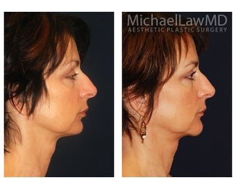 Chin Liposuction