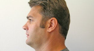 Facial Implant 