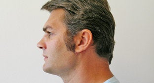 Facial Implant 